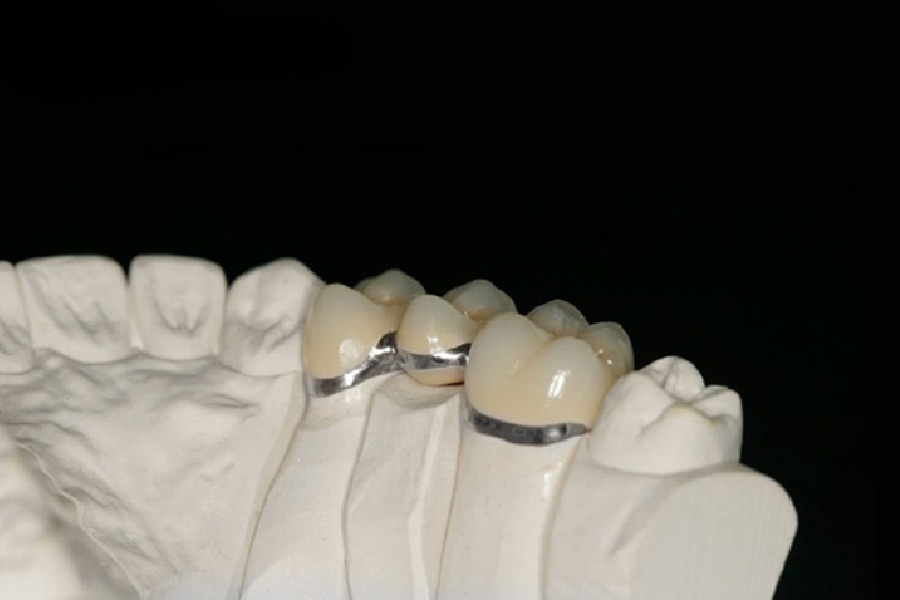Răng sứ Crom Cobalt lành tính, dù sử dụng lâu dài cũng không gây kích ứng