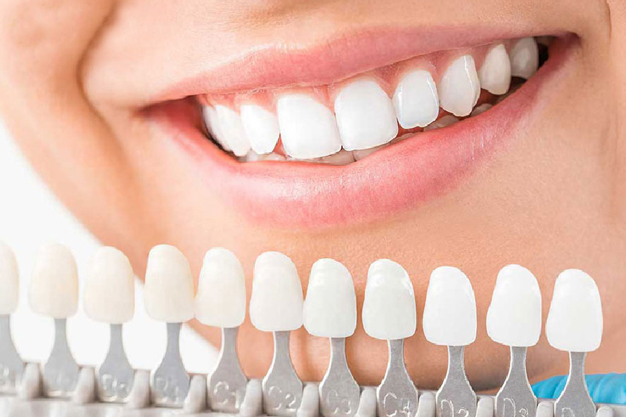 Mỗi nha khoa sẽ có giá bọc răng sứ HT Smile khác nhau